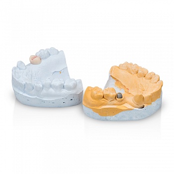 Культевая вкладка и восковое моделирование